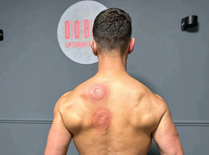 Cupping Therapy SmartCup